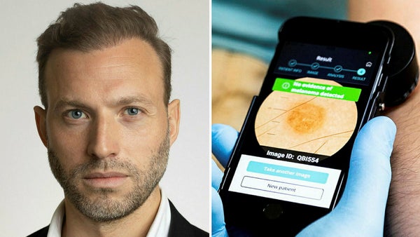 Grönt ljus för hudcancer-app: ”En av två i Europa”​​